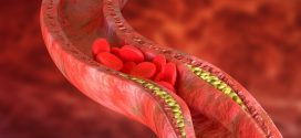 Actualització i noves teràpies farmacològiques per combatre la hipercolesterolèmia
